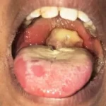 Schools Don Close As Diphtheria Outbreak Dey Kill People For One Imo Community