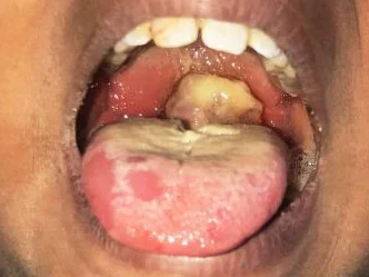 Schools Don Close As Diphtheria Outbreak Dey Kill People For One Imo Community